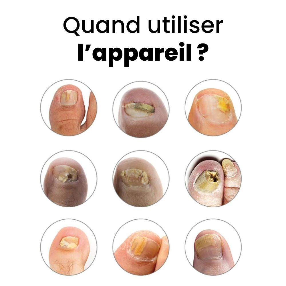 Appareil Anti-Mycose OrthoVital - Vue 6